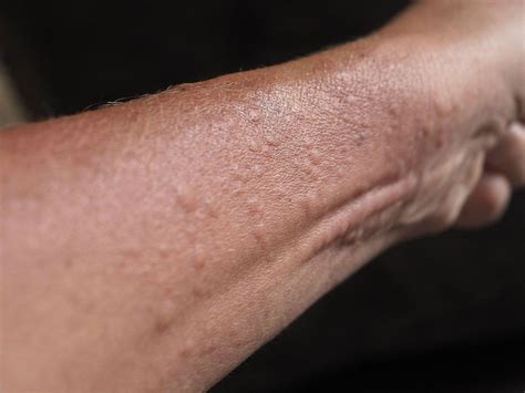 Common Childhood Skin Rashes With Pictures: What Rash Is This? - Which?