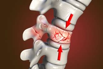 What is a Neck Fracture, and Can You Recover? - TCC