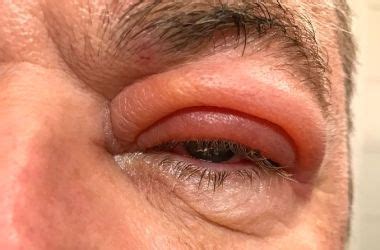 Eye Infections - What Should You Do?