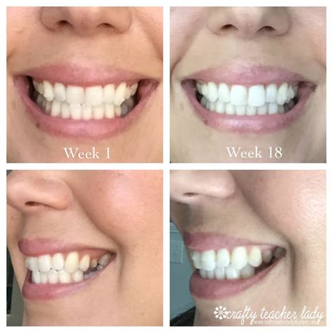 Invisalign Results Week By Week - Resultsha