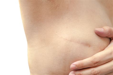 Everything You Need to Know About Getting a Mastectomy