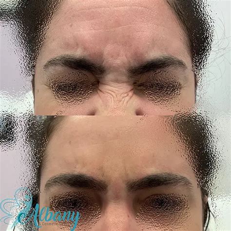 Bunny lines correction with Botox | Albany Medical Spa Edmonton