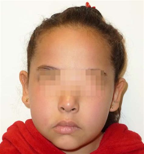 RBCP - Botulinum toxin in the treatment of asymmetric crying face syndrome: a case report