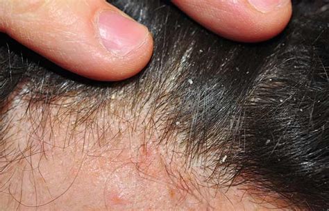 1. Dry Skin-Related Dandruff #DandruffRemoval #homeremedies #GoodHair #haircare | Dry skin ...