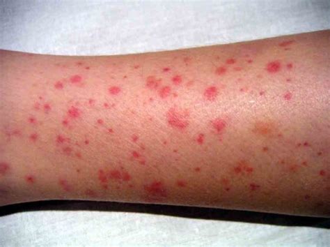 When to Worry about A Rash in Adults? - Page 13 of 15 - Healthella