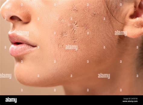 Blemished Skin High Resolution Stock Photography and Images - Alamy