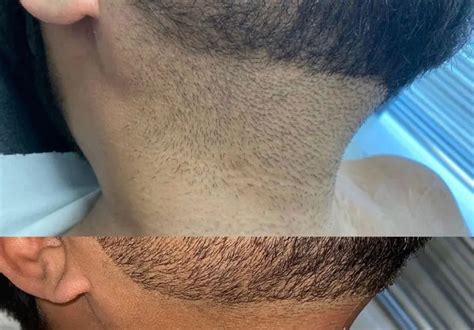 Why Laser Beard Shaping or Full Beard Removal Is Now a Thing!