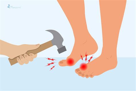 Can Gout Cause Ankle Swelling