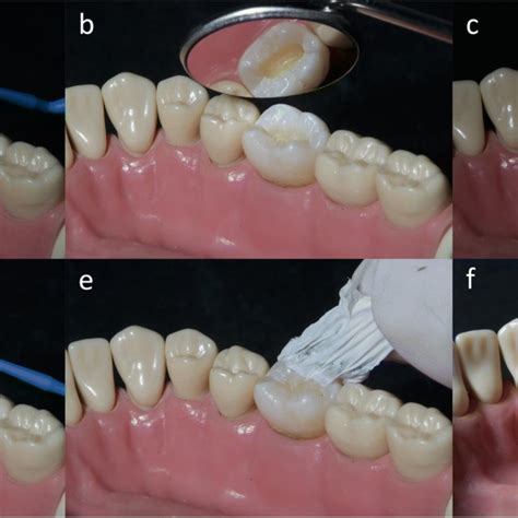 Rehabilitation of the occlusal surface with a resin-based composite... | Download Scientific Diagram