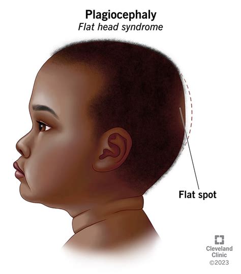 Plagiocephaly, Positional Plagiocephaly, Flat Head Syndrome: Causes ...