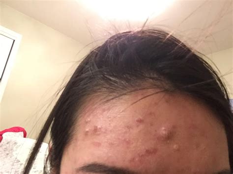 [Acne] Cystic acne on forehead and light acne everywhere else : r/SkincareAddiction