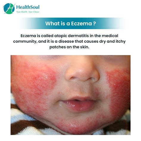 Symptoms Causes Types And Treaments Of Eczema Find Local | Hot Sex Picture