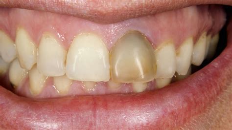 Black Stains On Teeth: Causes and Treatment in Bassendean