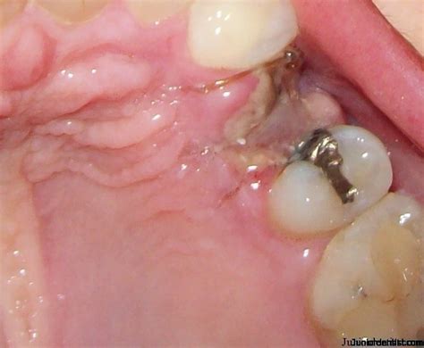 Dry Socket Pictures | Pictures of Alveolar Osteitis