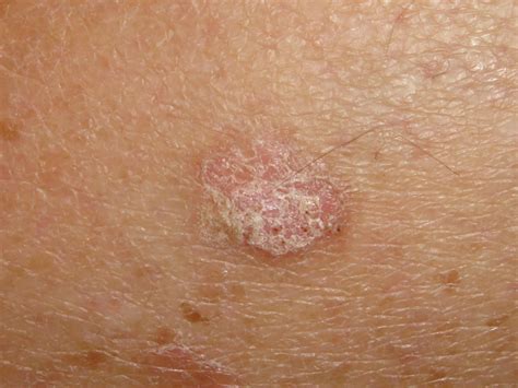 Actinic Keratosis (Solar Keratosis, Sun Spots) - Dermatology Advisor