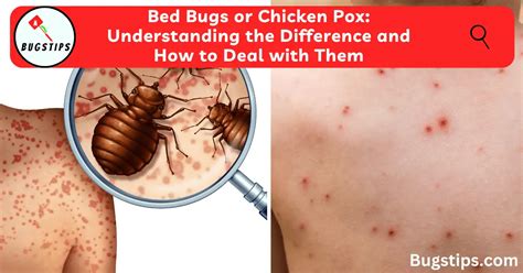 Bed Bugs or Chicken Pox: Understanding the Difference and How to Deal ...