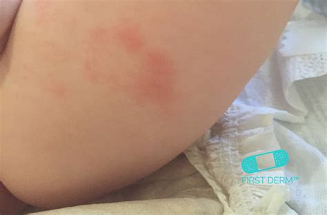 Yeast Diaper Rash (Candida Diaper Dermatitis): Symptoms,, 56% OFF