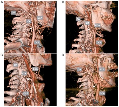 CTA of the ICA in different groups. (A) CTA illustrating mild ICA ...