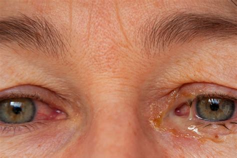 Eye Discharge: Causes, Treatment, and More | MyVision.org