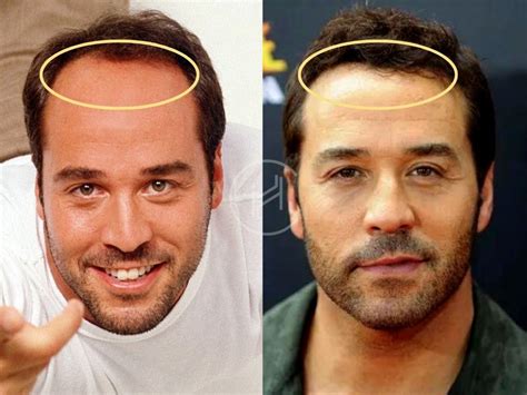 Jeremy Piven Hair Transplant - Hair Loss & Technical Analysis