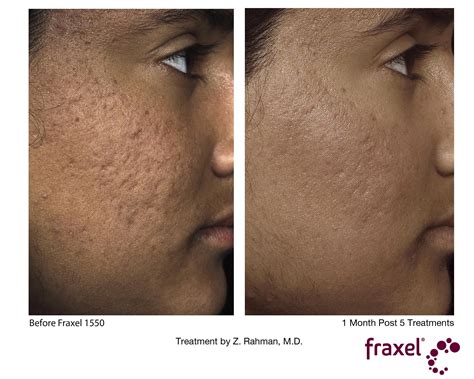 Fraxel Laser Before And After Acne Scars - change comin