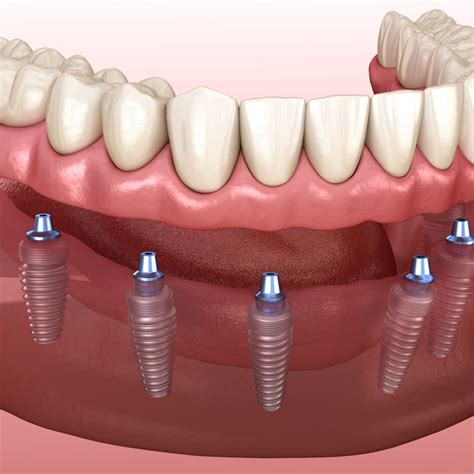 Implant-Supported Dentures | Pearland, TX Implant Dentists