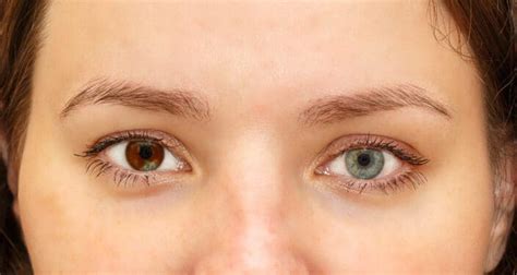 Heterochromia: When Does It Occur? (Types & Causes) – NVISION