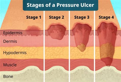 Bio-tribological advancements in Pressure Ulcer - About Tribology