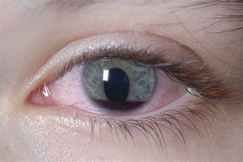 Eye injury causes, traumatic or chemical eye injury symptoms & treatment