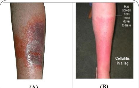 Image (A); typical severe cellulitis from clinical resource efficiency... | Download Scientific ...