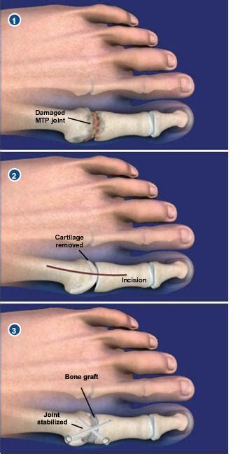 Arthritis Why It Hurts: Understanding Arthritis Pain - Mayra Flores