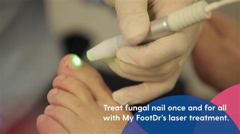 Toenail Fungus Laser Treatment Reviews 2015 - Quotes Trending