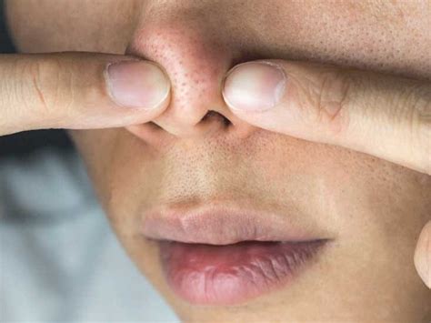 Hot To Easily Get Rid Of Bump On The Nose: Top 3 Tips ...