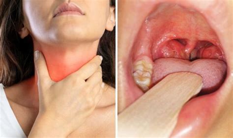 Tonsillitis symptoms in adults - Key differences between tonsillitis and Covid | Express.co.uk