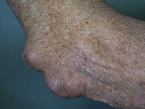 Rheumatoid arthritis | DermNet