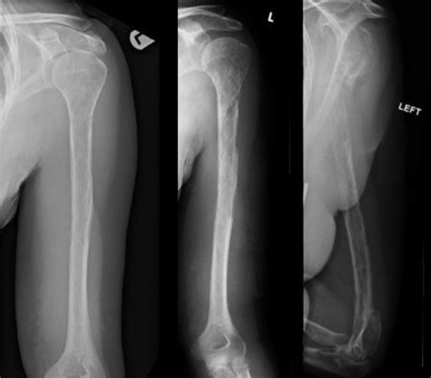 What is Vanishing Bone Disease? Woman's Arm Disappears From X-Ray