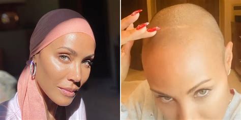 Jada Pinkett Smith's Hair Loss Is No Joke, It's A Condition Called Alopecia