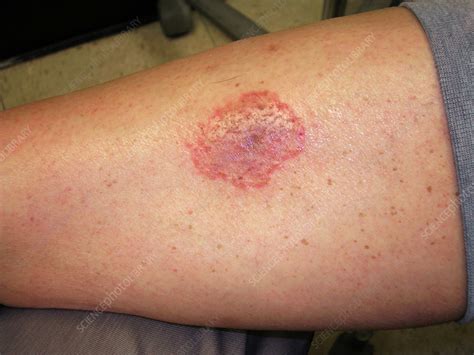 Pigmented purpuric dermatosis - Stock Image - C056/4968 - Science Photo Library