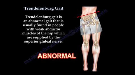 Trendelenburg Gait - Everything You Need To Know - Dr. ... | Doovi