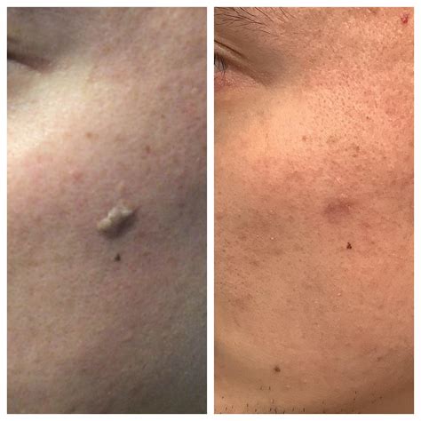 Seborrheic Keratosis Removal Before and After St. Louis Dermatology & Cosmetic Surgery ...