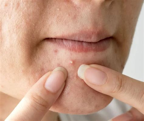 Hormonal Acne Guide - Types, Causes, Treatment & more | ELARA CARE