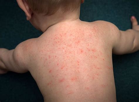 D Austin Hill: Measles Symptoms In Toddlers