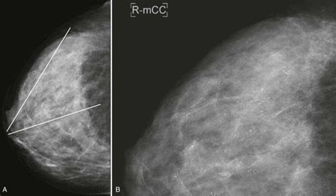 Calcifications Made Easy | Radiology Key