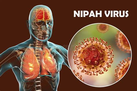 Nipah Virus, Newly Emerging Zoonotic Infection with Respiratory ...