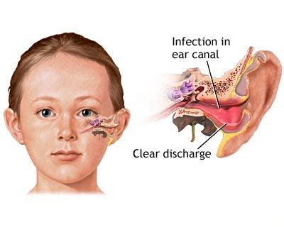 Ear Canal Infection - Causes, Symptoms, Treatment, Pictures | HealthMD