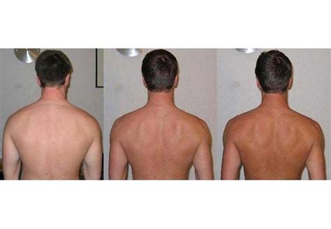 Before and after Melanotan tanning therapy, sunless tanning results