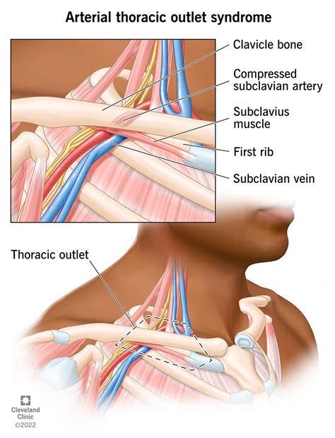 Arterial Thoracic Outlet Syndrome: Causes & Symptoms