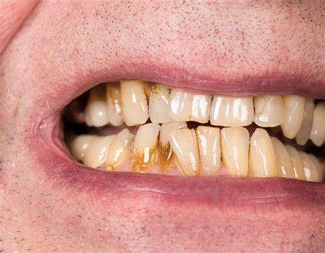Receding Gums – Know About Its Causes, Symptoms, and Treatment - Healthwire