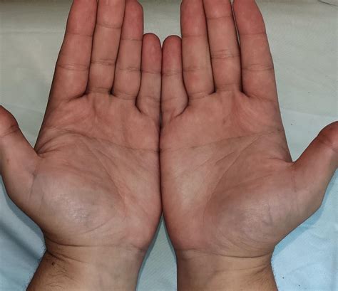 Both of my hands have a single transverse palmar crease : r/mildlyinteresting