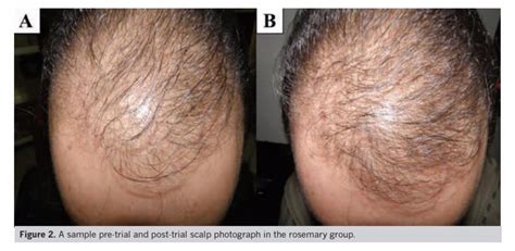 slsi.lk - how long for sulfatrim to work | Does spironolactone really help with hair loss ...